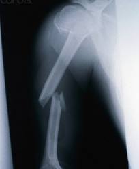 Can-Do-Ability: Researchers Invent Miracle Fracture Putty To Heal Broken Bones